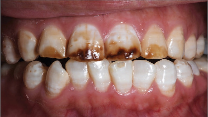 Dental Fluorosis: Types, Prevention and Treatments
