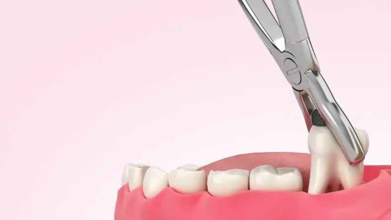 Healing after Tooth Extraction: Key Precautions to Ensure a Smooth Recovery