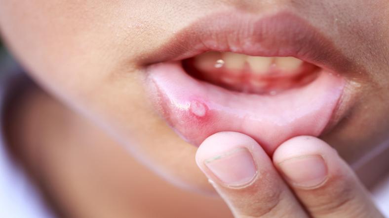 How to Treat and Prevent Oral Sores