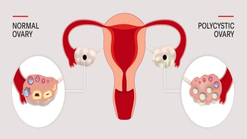 PCOS - Symptoms, Causes, Diagnosis, Treatment, Recovery PCOS - Symptoms, Causes, Diagnosis, Treatment, Recovery