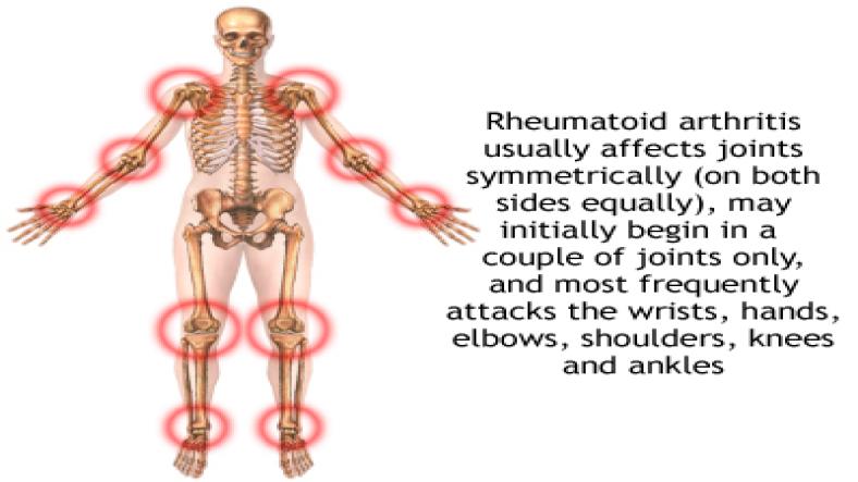 Rheumatoid Arthritis - Symptoms, Causes, Diagnosis, Treatment, Recovery Rheumatoid Arthritis - Symptoms, Causes, Diagnosis, Treatment, Recovery