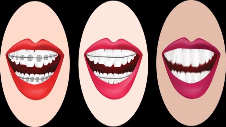 Understanding the Different Types of Braces